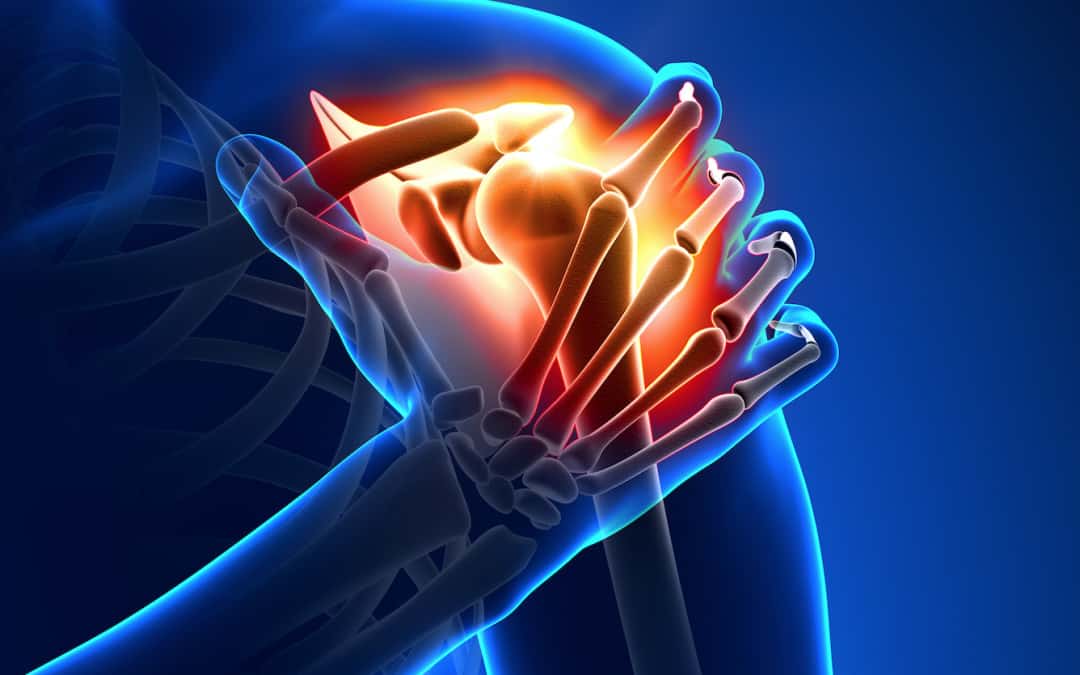 Informareonline-calcificazione-alla-spalla