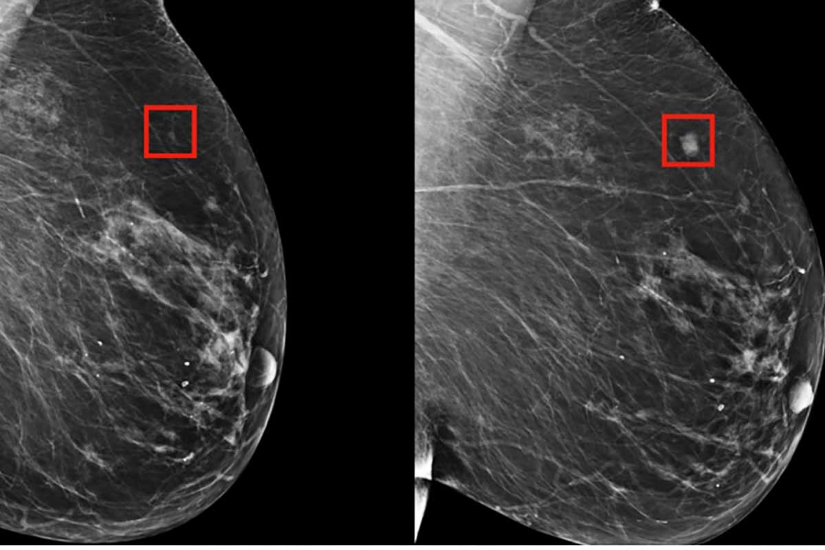 Tumore al seno, gli sviluppi della medicina: il ribociclib