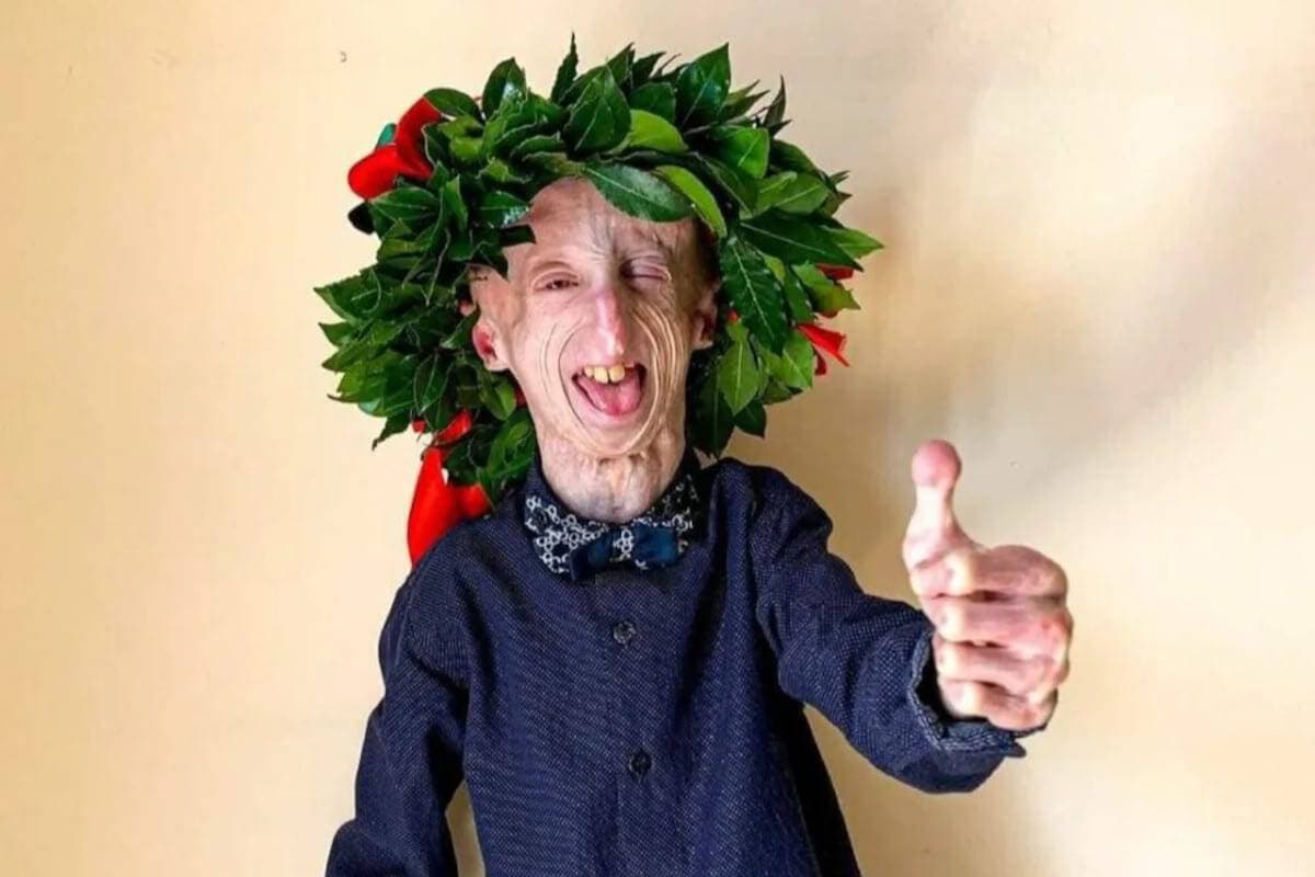 Sammy Basso è morto: era il più longevo malato di Progeria al mondo