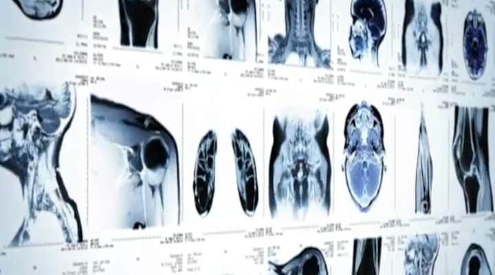 Radiomica e machine learning alleati dell’ortopedia oncologica