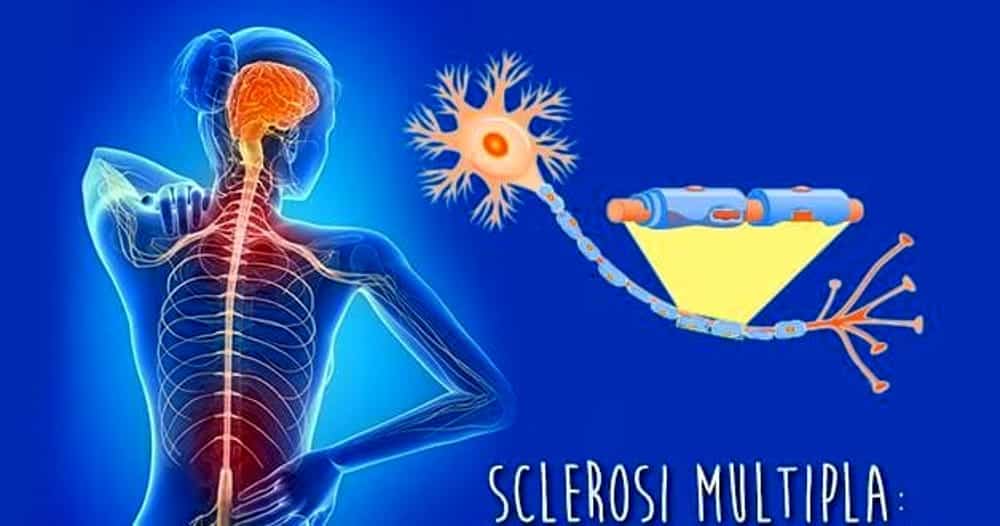 Sclerosi multipla-Immagine