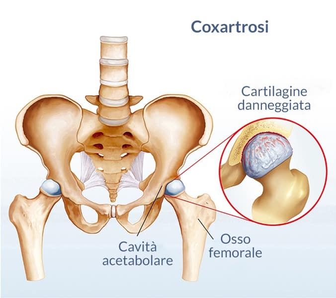 Metodo Bonori: un trattamento per l’artrosi dell’anca