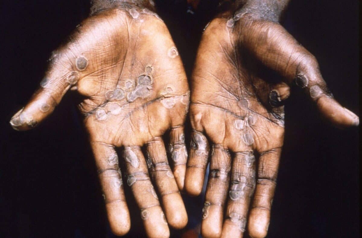 Monkeypox, vaiolo delle scimmie: 5 casi in Italia