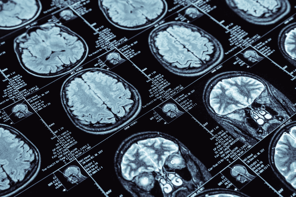 Leqembi, il farmaco che rallenta l'Alzheimer autorizzato negli USA dalla Fda