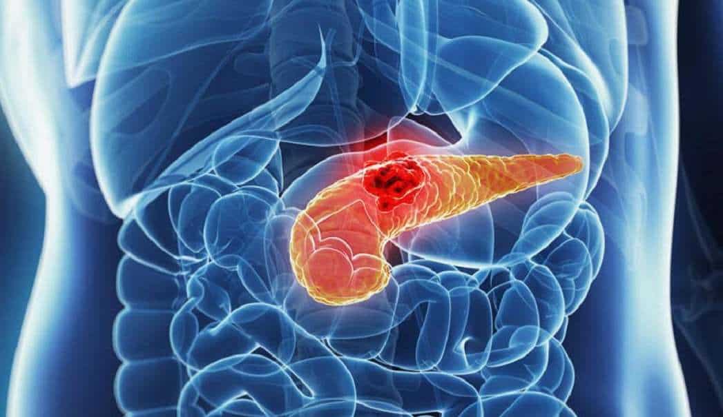 Perché il tumore del pancreas è tra le malattie più pericolose?