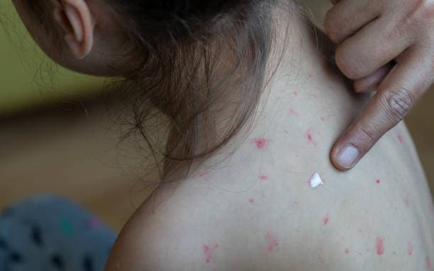Morbillo, casi in aumento in Italia: "L'epidemia è partita"